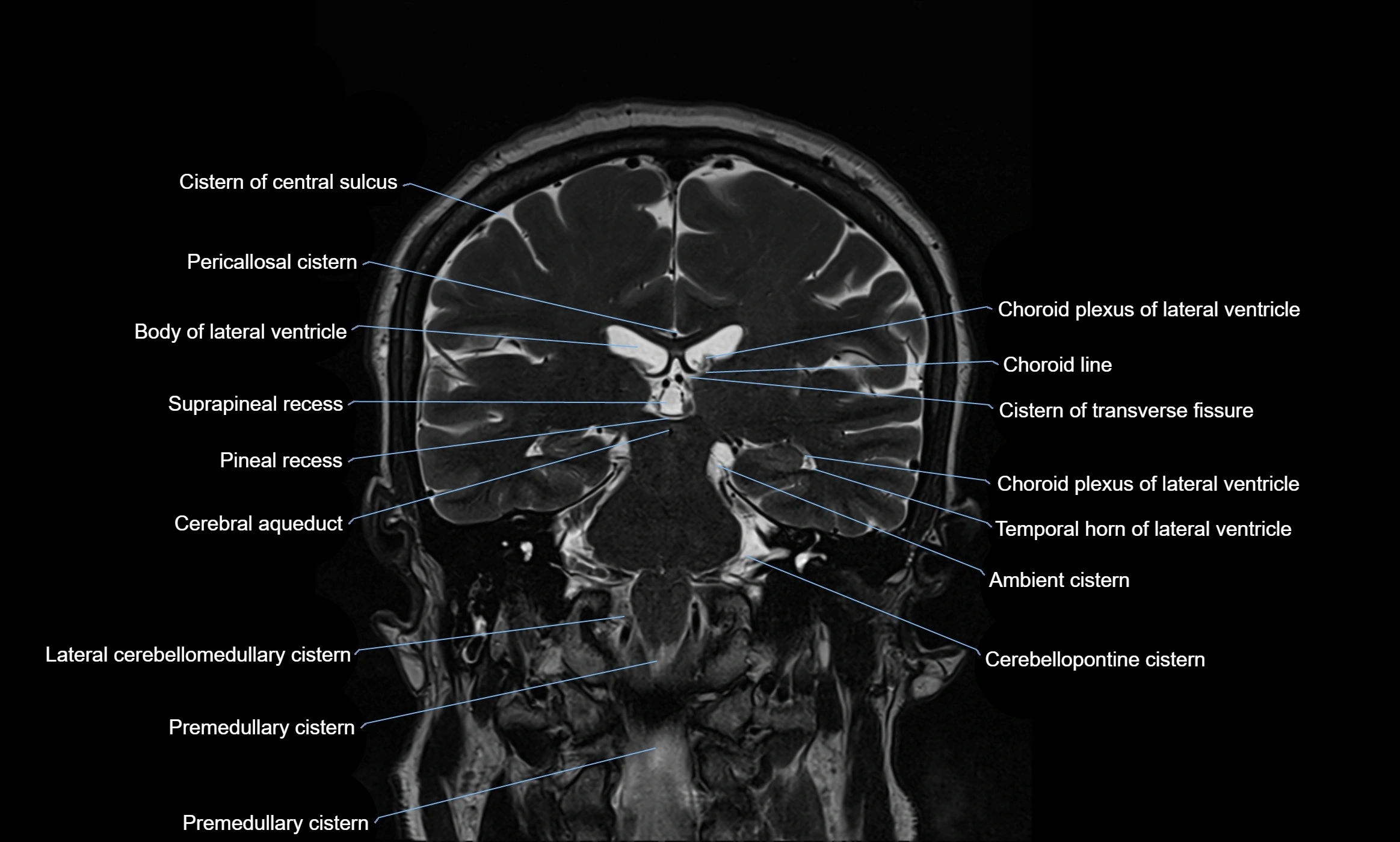 Brain cisterns  and ventricles coronal anatomy 3T MRI image-img-00001-00035.webp